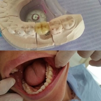 Corona dentale in zirconia su impianto