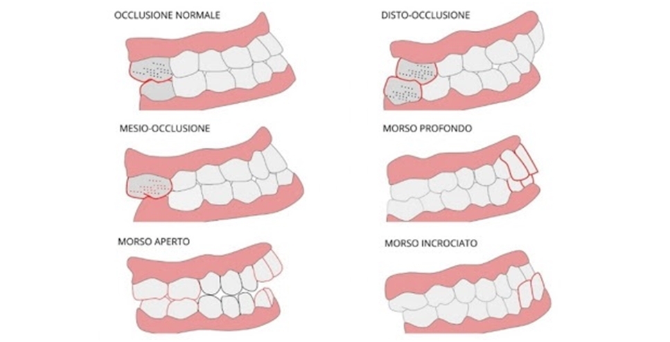 Malocclusione dentale